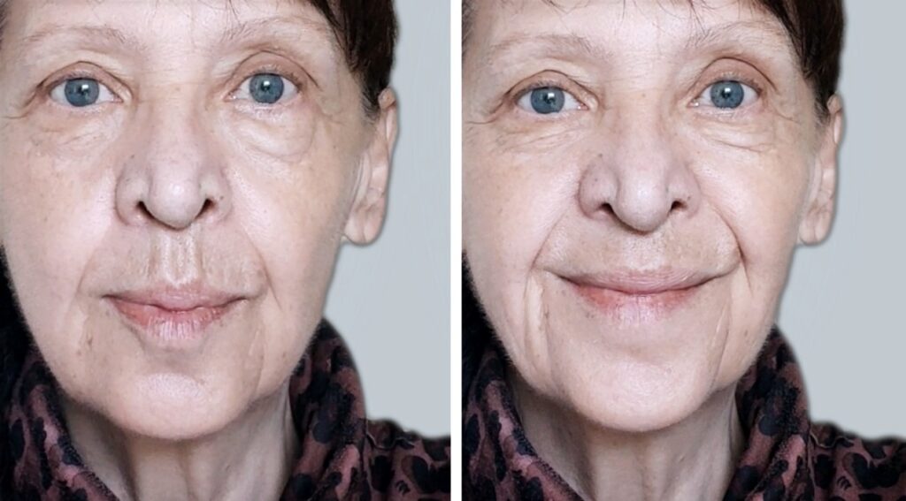 a womans appearance after a year of facial massages A woman's appearance after a year of self facial massages.